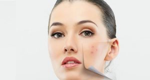 Acne treatment in Singapore