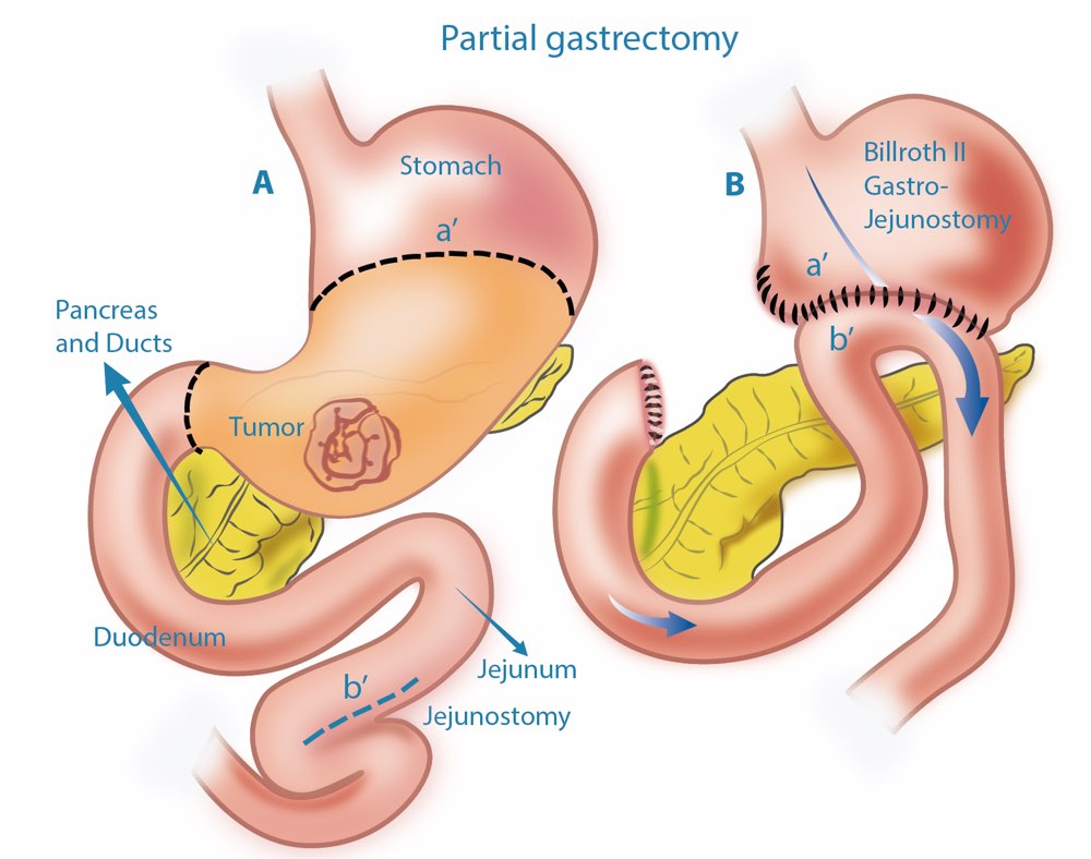 gastric cancer surgery Singapore