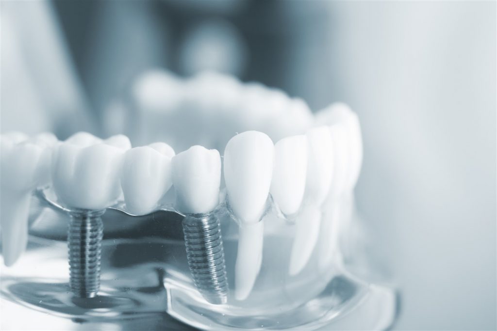 dental implants newport new va